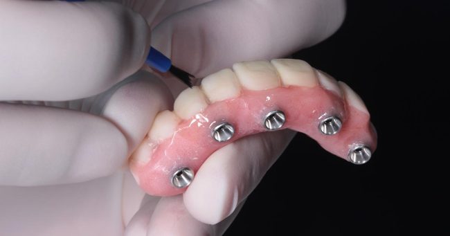 Evanston Dental Implants